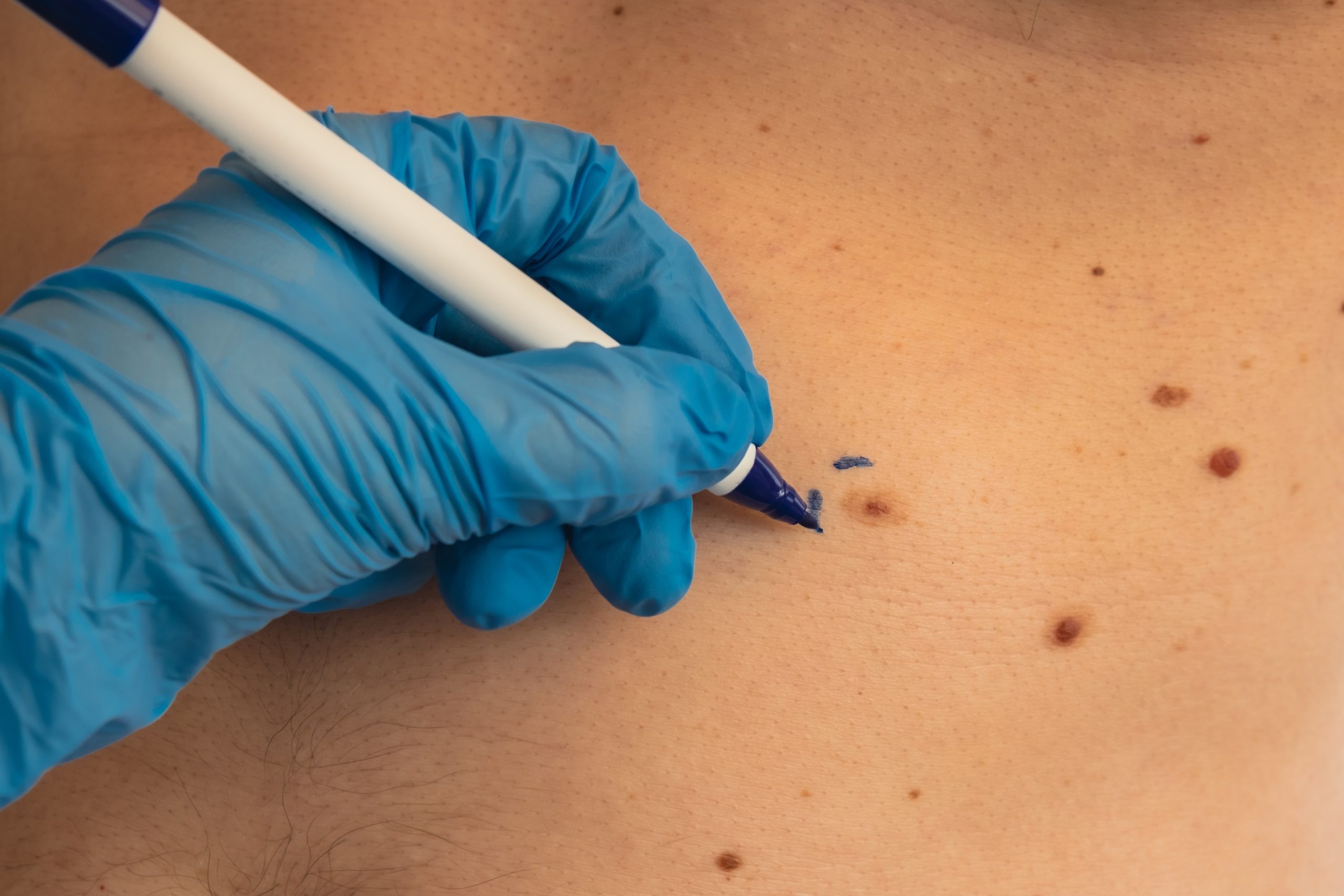 Chirurgie dermatologica